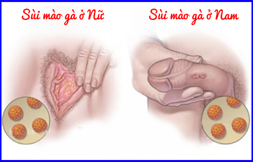 Triệu chứng sùi mào gà ở nam và nữ